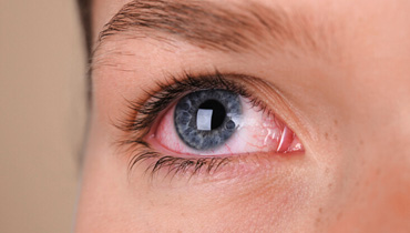 ResuMED de síndrome do olho vermelho: causas, exames e mais!