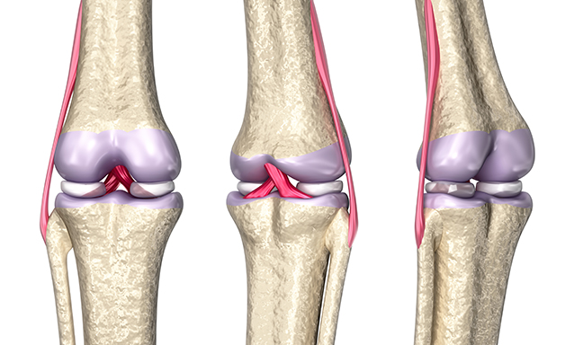 Lesão meniscal: Tudo o que você precisa saber!