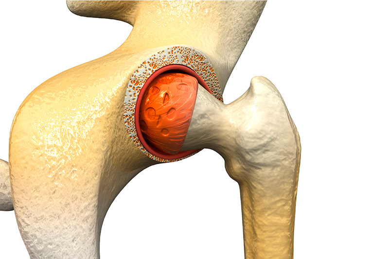 Osteoartrose no quadril não tem cura?: MITO OU VERDADE?