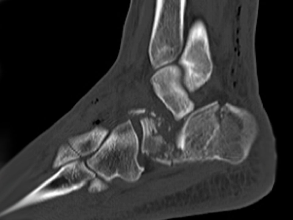 Fratura do calcâneo, a cirurgia é necessária?